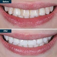 Metro smiles offers philips zoom whitespeed, the best and most effective professional teeth whitening system. Zoom Whitening In Brooklyn Ny Laser Teeth Whitening