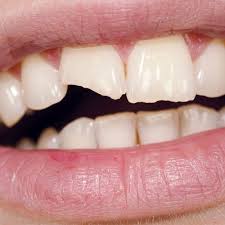 Broken or cracked teeth repair and treatment. It S Easy And Smart To Fix A Chipped Tooth Broken Tooth Repair Tooth Repair Broken Tooth