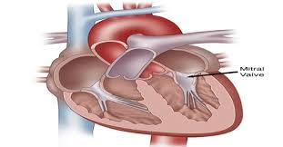 Qui a la forme d une mitre. Mitral Valve Assignment Point