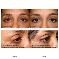 I Want My Eyes Back One Of The Most Complicated Complications To Fix Regarding Cosmetic Eyelid Surger Eyelid Surgery Transformation Tuesday Instagram Posts