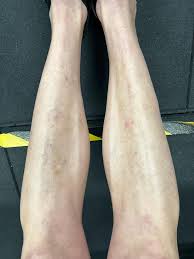 Image result for Pigment stains on the shin