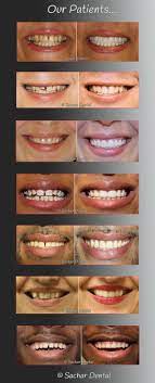 Cosmetic Dentist Nyc | Smile Makeovers Nyc | Sachar Dental Nyc