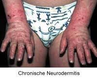 We did not find results for: Starker Juckreiz Bei Neurodermitis Neurodermitistest Gesundheit Aktuell De