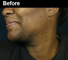 This is because nd:yag laser emits a longer pulse (beam of light) that can penetrate deeper into the skin, therefore, minimizing any skin damage surrounding the hair. Laser Hair Removal Before And After Pictures Wifh