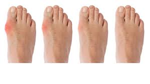 Image result for gout