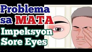 Problema sa Mata: Impeksyon, Sore Eyes at Tamang Gamutan, Payo ni Doc  Frances Roa-Lingad at Doc Willie Ong , May bagong sakit na kumakalat sa  mata