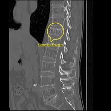 Learn vocabulary, terms and more with flashcards, games and other study tools. Osteoporosis X Ray Wikidoc