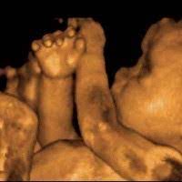 Pada sebagian besar wanita hamil, gejala ini muncul sepanjang trimester pertama hingga menginjak. Kondisi Ibu Hamil Di Trimester Ketiga 3