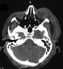 Necrotizing fasciitis is a rare infection that spreads along the superficial fascia, compromising the subcutaneous tissue between the skin and underlying muscle. Necrotizing Fasciitis Ophthalmology