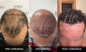 Gonfiore intorno al viso e principalmente intorno agli occhi può capitare raramente per un alcuni giorni post intervento. Galleria Trapianto Capelli Turchia