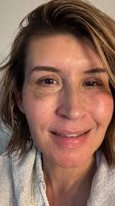 Blepharoplasty Support Group