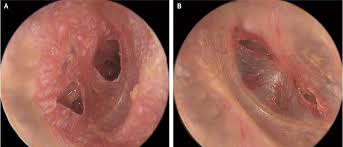 The eardrum, also known as the tympanic membrane, is a thin layer of tissue that separates the outer ear from the middle ear. Wedding Fireworks Ruptured Man S Eardrums Live Science