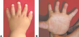 A chest wall deformity and also an abnormality in the hand was noted from this individual. Single Stage Separation Of 3 And 4 Finger Incomplete Simple Syndactyly With Contiguous Gull Wing Flaps A Technique To Minimize Or Avoid Skin Grafting Journal Of Hand Surgery