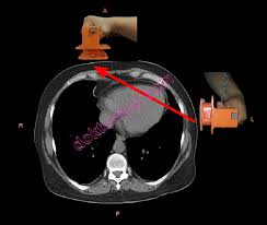 In 1956, alternating current (ac) defibrillation was first introduced to treat ventricular fibrillation in humans. Electrical Cardioversion Electro Shock Treatment Defibrillation D C Cardioversion Doktorekg Com Elektrokardiyografi Ekg Electrocardiography Ecg Ankara Kardiyoloji Kalp Hastaliklari Doktorekg Com