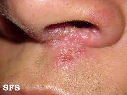 Există două tipuri de herpes: De Ce Apare Herpesul Peste 10 Cauze GraÈ›iela Vlad