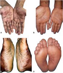 Image result for Secondary Syphilis