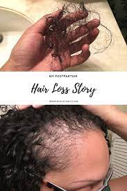 My Postpartum Hair Loss Shedding Story Discocurls Postpartum Hair Loss Hair Loss Hair Shedding Remedies