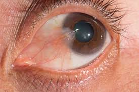 In other words, they are very fond of someone or something. What Does A White Spot On My Eyeball Mean The Eye News