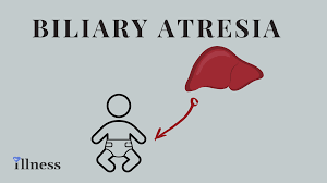Early surgical intervention to treat biliary atresia is critical to prevent irreversible liver damage. Biliary Atresia Overview Causes Symptoms Treatment Illness Com