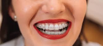 Standard metal braces generally cost between $5,000 to $6,000. Brace Yourself For The Perfect Smile How Braces Work Hamburg Dental Care