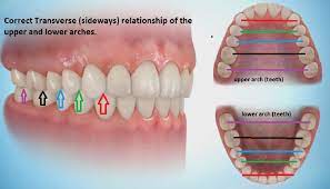 Sideways Expansion In Orthodontics Clonmel Orthodontics