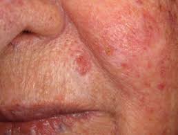 Skin cancer is the most common type of cancer in the united states by a pretty large margin, and it does not discriminate. Basal Cell Carcinoma Affecting The Face Images Dermnet Nz
