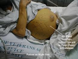 Image result for Shifting Dullness Test