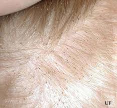 Check spelling or type a new query. Getting Rid Of Fleas In Human Hair Thriftyfun