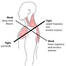 Upper Crossed Syndrome Illinois Chiropractic Society