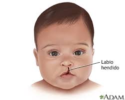 Realizan colecta juntos, devolvamos sonrisas para atender a niños con labio fisurado y paladar hendido. Cirugia De Labio Y Paladar Hendido Serie Indicaciones Medlineplus Enciclopedia Medica