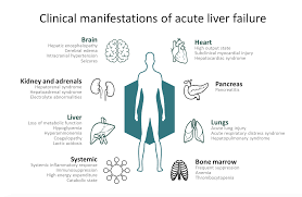 Emdocs Net Emergency Medicine Educationacute Liver Failure Evidence Based Evaluation And Management Emdocs Net Emergency Medicine Education