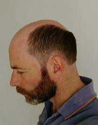 Pin By Cmb On Mpbilf Bald Men With Beards Male Pattern Baldness Bald Men