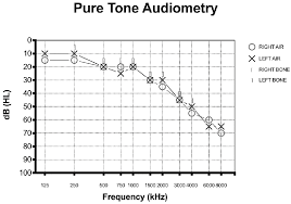 Image result for Presbycusis