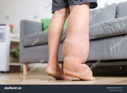 Image result for Tropical Edema