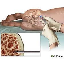 Bone marrow cancer can have a favorable outcome if detected and treated early. Bone Marrow Failure In Children What You Need To Know