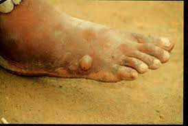 A similar infestation also occurs in animals,' and a related species, dracunculus insignis, is known to infect racoons, mink, and dogs.2 the disease, at the present time, has a wide distribution throughout tropical and subtropical regions ofthe world. Dracontiasis Med Kom