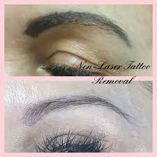Webmasters, you can add your site in. Tattoo Removal Distinctive Features