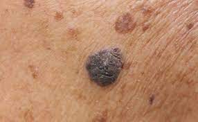 Melanoma is the rarest form of skin cancer, and the only one linked to new or changing moles. Pin On Get Rid Of Moles