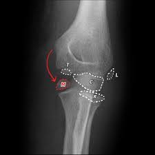 This typically occurs at two main sites: Epicondyle Fracture Elbow Radiology Reference Article Radiopaedia Org