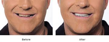 3,088 likes · 1 was here. Snap On Smile Dentist Wapakoneta Oh Dental Education Library