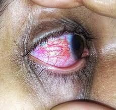 Image result for Conjunctivitis Resources