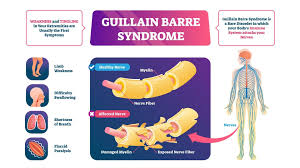 The first symptoms of gbs are usually tingling and muscle weakness that begins in the lower. Guillain Barre Syndrome Treatment Propel Physiotherapy