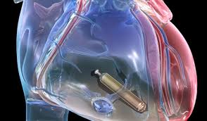 It implements several apis for controlling resources. Is Your Heart A Good Candidate For A Leadless Pacemaker Health Essentials From Cleveland Clinic