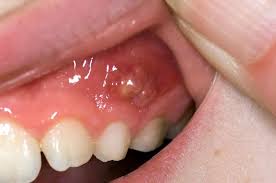 Image result for Periodontal Abscess