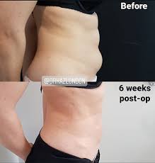 Image result for Liposuction