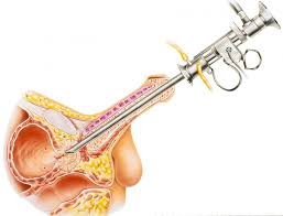 What Happens When You Have Prostate Surgery Prostate Surgery Prostate Types Of Surgery