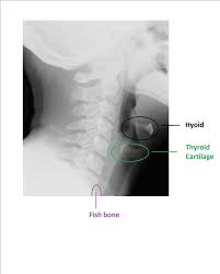Does Vinegar Really Help To Dissolve Fish Bones Stuck In Your Throat Quora