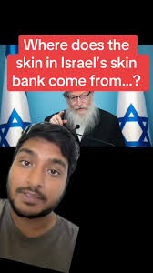 Ireal Largest Skin Bank