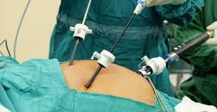 Laparoscopic Gallbladder Stone Operation 5 Simple Tips To Follow For A Faster Recovery Gallbladder Stones Surgery Recovery Gallbladder Surgery