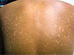 Condition characterized by a rash on the trunk and proximal extremities. Tinea Versicolor Causes Signs Symptoms Treatment Remedies